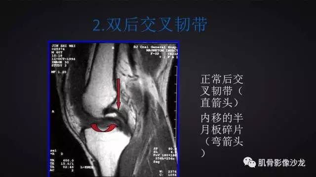 【PPT】膝关节解剖和半月板损伤影像解读