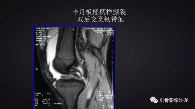 【PPT】膝关节解剖和半月板损伤影像解读