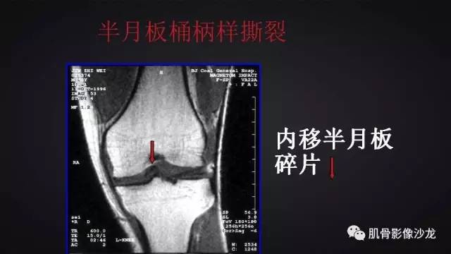 【PPT】膝关节解剖和半月板损伤影像解读