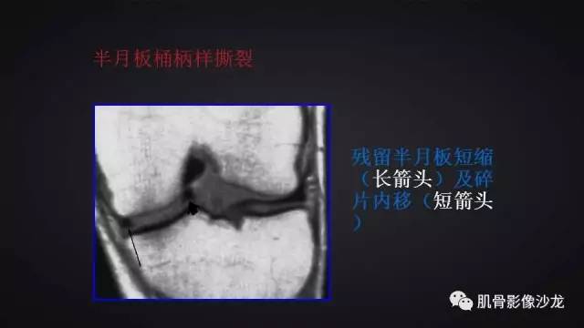 【PPT】膝关节解剖和半月板损伤影像解读