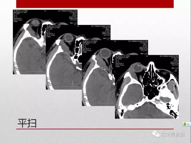 【病例】右泪腺多形性腺瘤1例CT影像表现