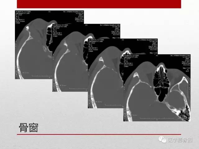 【病例】右泪腺多形性腺瘤1例CT影像表现