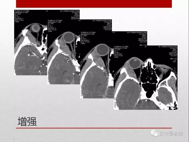 【病例】右泪腺多形性腺瘤1例CT影像表现