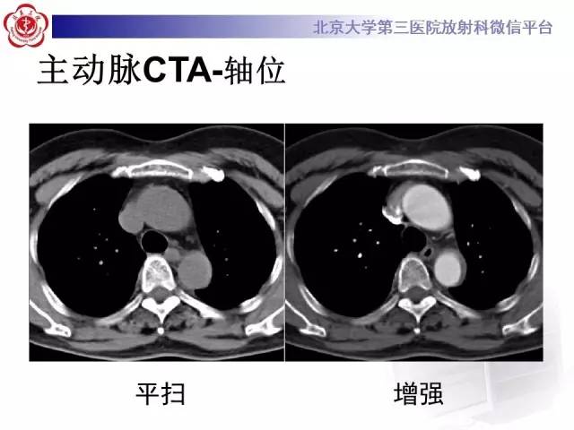 【病例】主动脉壁内血肿1例CT影像表现