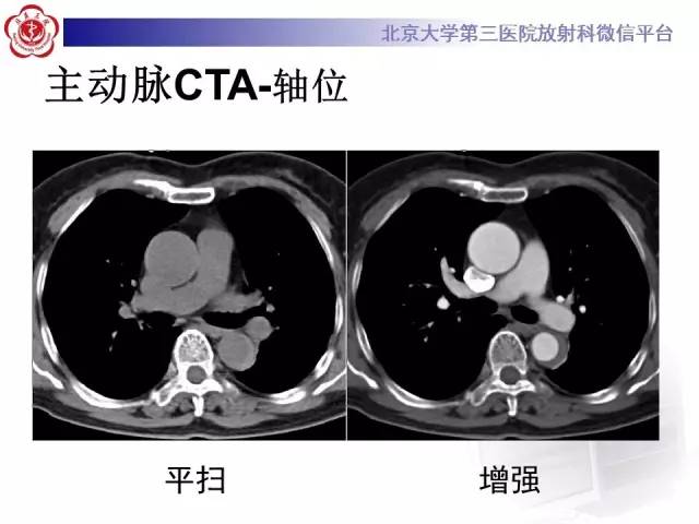 【病例】主动脉壁内血肿1例CT影像表现