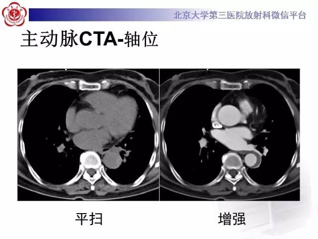 【病例】主动脉壁内血肿1例CT影像表现