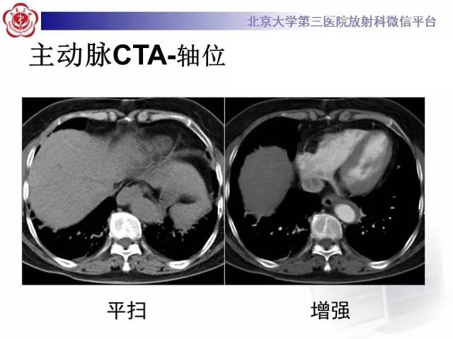 【病例】主动脉壁内血肿1例CT影像表现