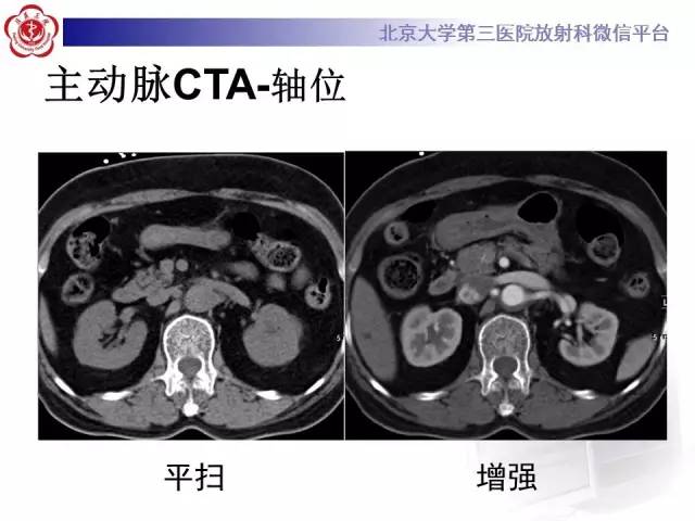 【病例】主动脉壁内血肿1例CT影像表现