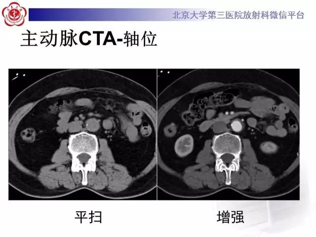 【病例】主动脉壁内血肿1例CT影像表现