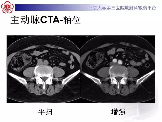 【病例】主动脉壁内血肿1例CT影像表现