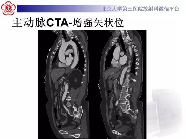 【病例】主动脉壁内血肿1例CT影像表现