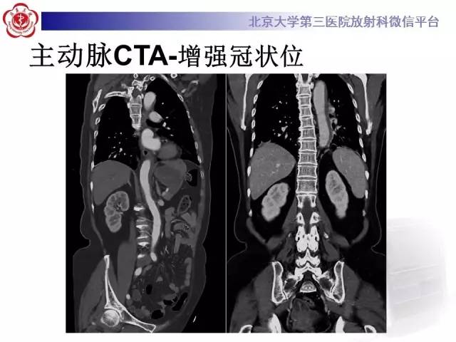 【病例】主动脉壁内血肿1例CT影像表现