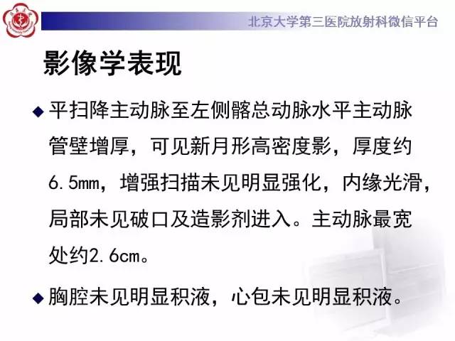 【病例】主动脉壁内血肿1例CT影像表现