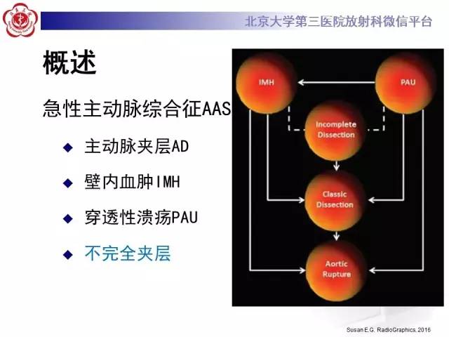 【病例】主动脉壁内血肿1例CT影像表现