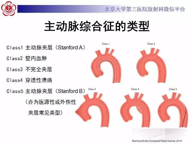 【病例】主动脉壁内血肿1例CT影像表现