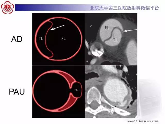 【病例】主动脉壁内血肿1例CT影像表现