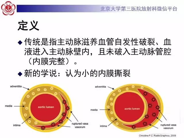 【病例】主动脉壁内血肿1例CT影像表现