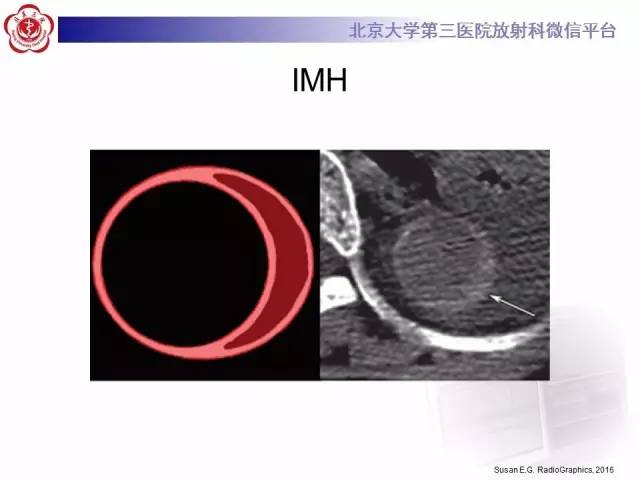 【病例】主动脉壁内血肿1例CT影像表现