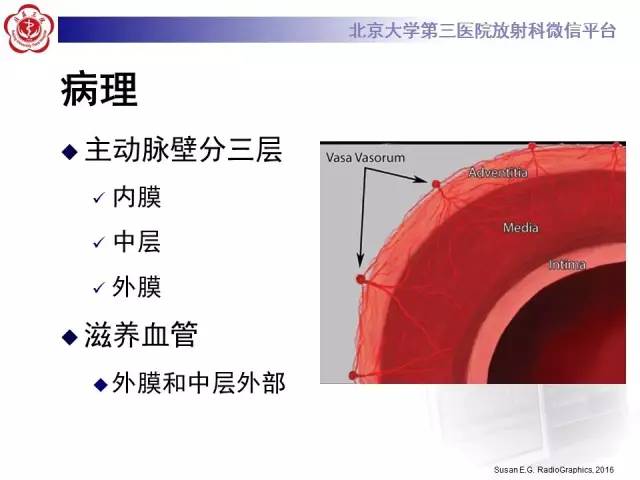 【病例】主动脉壁内血肿1例CT影像表现