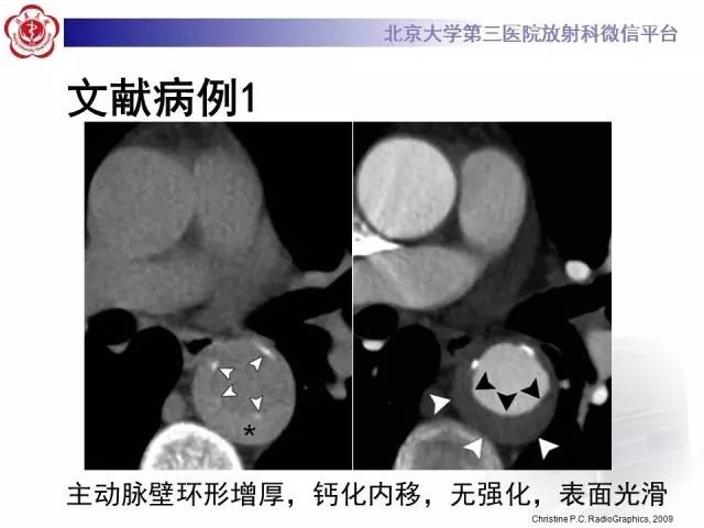 【病例】主动脉壁内血肿1例CT影像表现