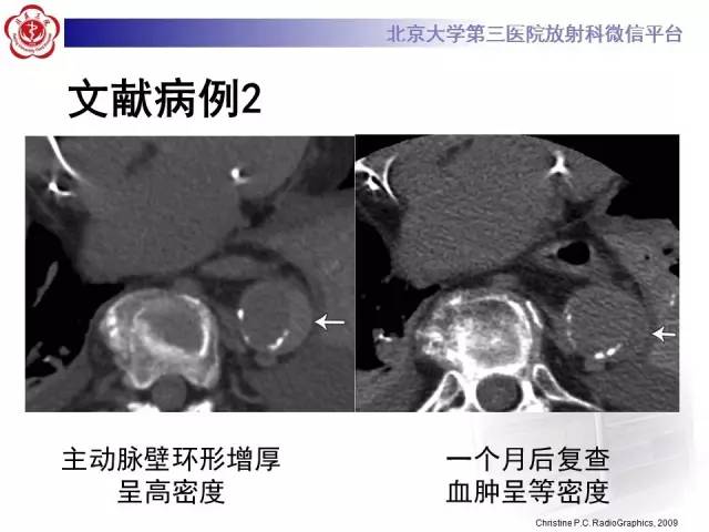 【病例】主动脉壁内血肿1例CT影像表现