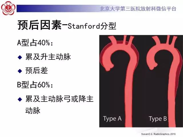 【病例】主动脉壁内血肿1例CT影像表现