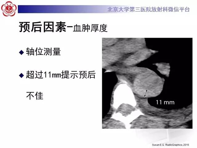 【病例】主动脉壁内血肿1例CT影像表现