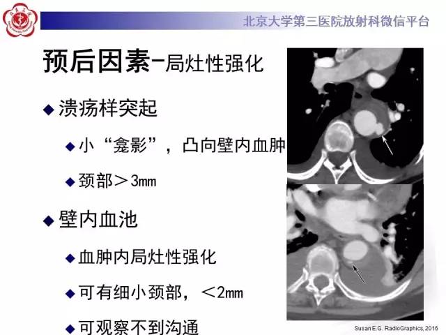 【病例】主动脉壁内血肿1例CT影像表现