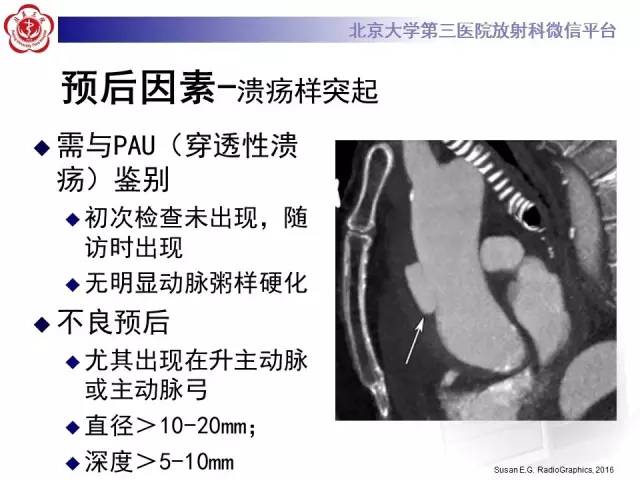 【病例】主动脉壁内血肿1例CT影像表现