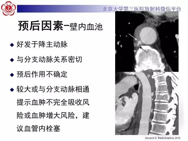 【病例】主动脉壁内血肿1例CT影像表现