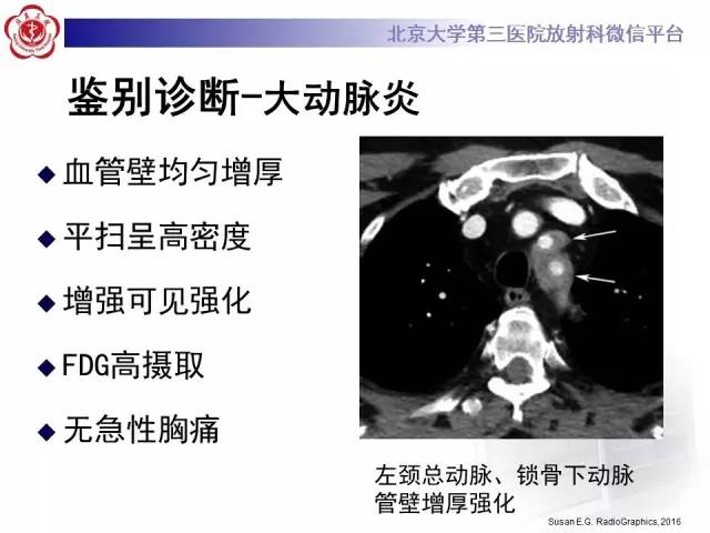 【病例】主动脉壁内血肿1例CT影像表现