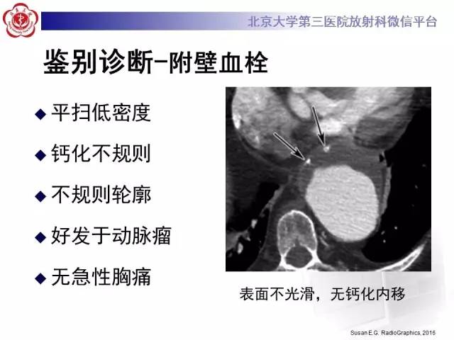 【病例】主动脉壁内血肿1例CT影像表现