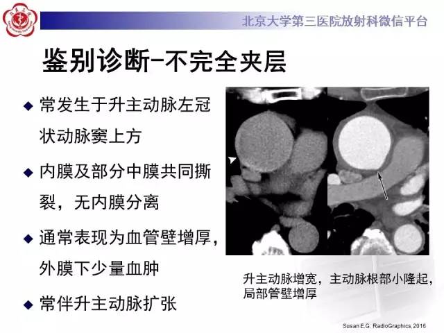 【病例】主动脉壁内血肿1例CT影像表现