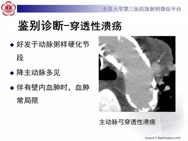 【病例】主动脉壁内血肿1例CT影像表现