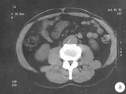【病例】腹膜后纤维化1例CT影像表现 【病例】腹膜后纤维化1例CT影像表现