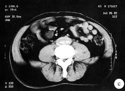 【病例】腹膜后纤维化1例CT影像表现 【病例】腹膜后纤维化1例CT影像表现