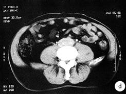 【病例】腹膜后纤维化1例CT影像表现 【病例】腹膜后纤维化1例CT影像表现