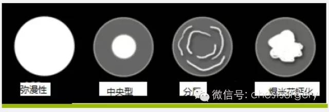 孤立性肺结节的各种影像学表现总结