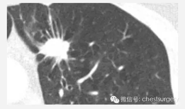 孤立性肺结节的各种影像学表现总结