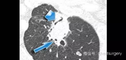 孤立性肺结节的各种影像学表现总结
