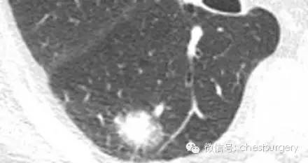 孤立性肺结节的各种影像学表现总结