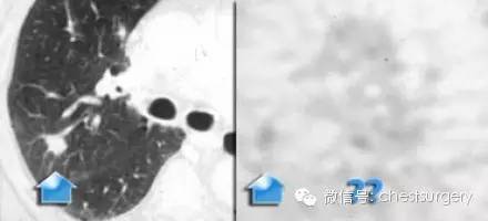 孤立性肺结节的各种影像学表现总结