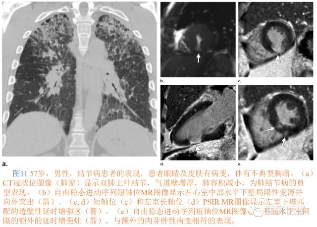 心脏结节病的影像与病理对照 心脏结节病的影像与病理对照