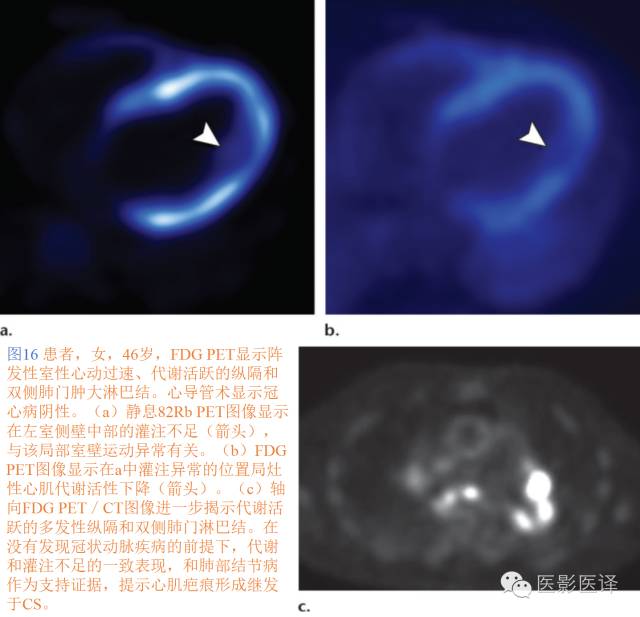 心脏结节病的影像与病理对照 心脏结节病的影像与病理对照