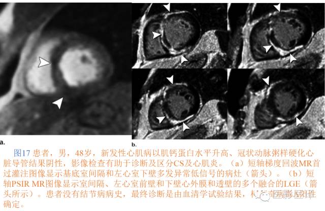 心脏结节病的影像与病理对照 心脏结节病的影像与病理对照