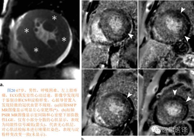 心脏结节病的影像与病理对照 心脏结节病的影像与病理对照