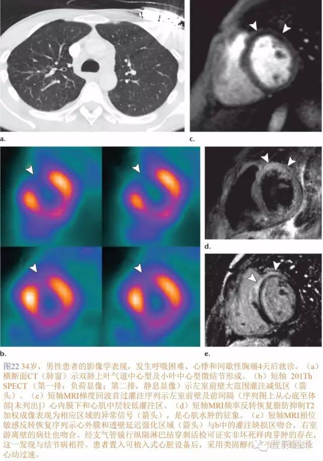 心脏结节病的影像与病理对照 心脏结节病的影像与病理对照