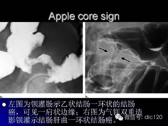 【PPT】一些经典影像征象图文解析
