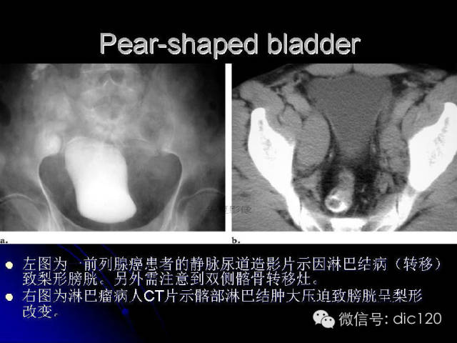 【PPT】一些经典影像征象图文解析