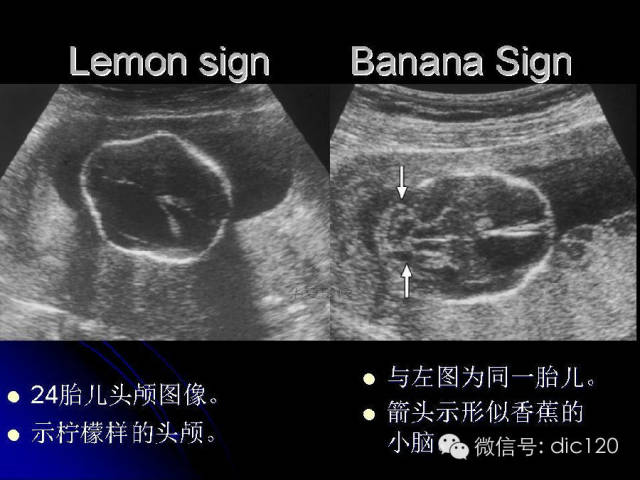 【PPT】一些经典影像征象图文解析